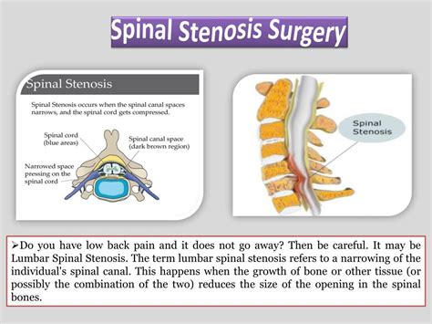 Ppt Lumbar Spinal Stenosis Surgery Powerpoint Presentation Free
