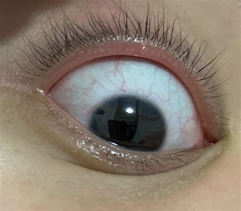 Clear Bumps On The Rim Of My Eyelids Info In Comments Roptometry