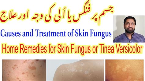 Fungal Skin Infection Fungal Infection Tinea Versicolor Treatment