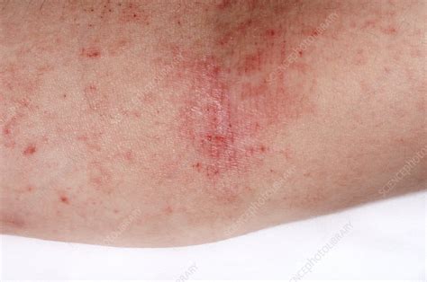 Eczema On The Arm Stock Image C0110369 Science Photo Library