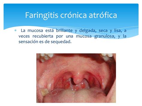 Faringitis Cronica