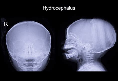Hydrocephalus In Babies Causes Signs And Treatment