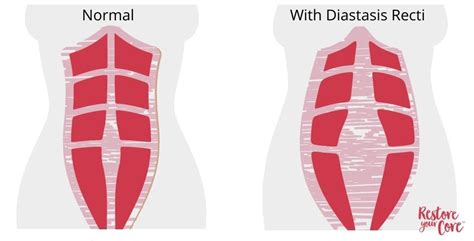 The Archive Place Restore Your Core Publishes Diastasis Recti And