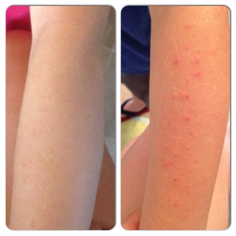 Eczema Before And After Using Botanic Fusions Alleviator