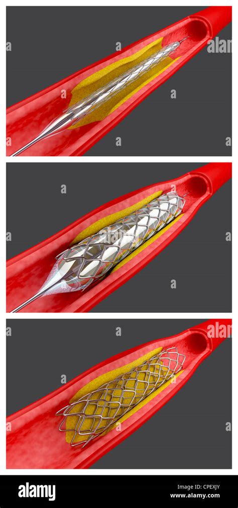 Balloon Angioplasty Procedure With Placing A Stent Stock Photo Alamy