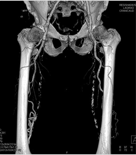 Cta With De With Superficial Femoral Artery Sfa Occlusion And
