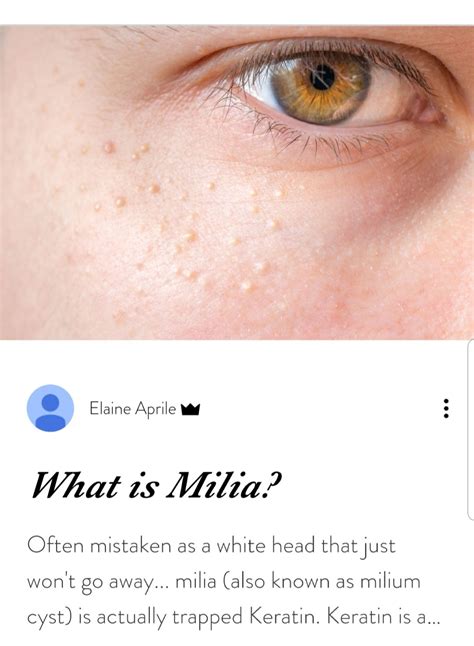 White Bumps Under Eyes Milia Artofit