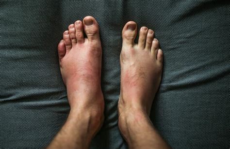 Psoriatic Arthritis Toes Psoriatic Arthritis Hands