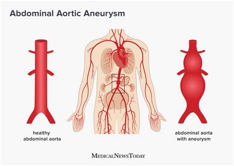 Abdominal Aortic Aneurysm Screening Treatment And Symptoms