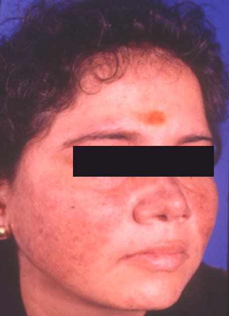 External Photograph Of Patient With Systemic Lupus Erythematosus