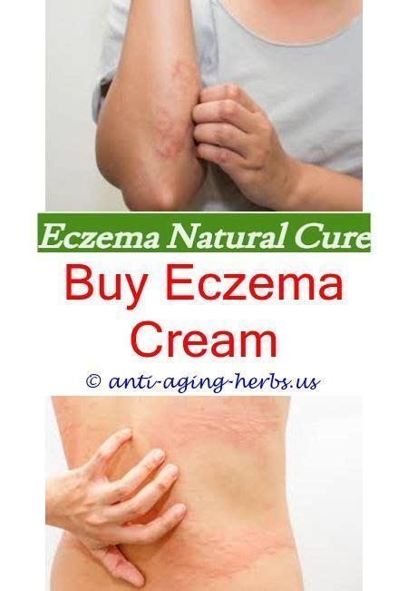 Mild Eczema On Neck Foods That Trigger Eczema Outbreaks