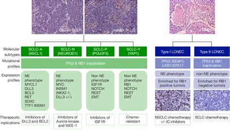 Figure 1 From New Molecular Classification Of Large Cell Neuroendocrine