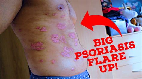 Biologics Have Stopped Working Big Psoriasis Winter Flare Up New