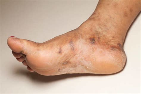 Tips For Soothing Foot Psoriasis