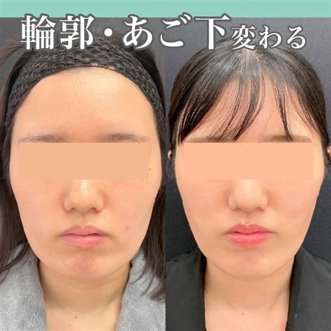 小顔脂肪吸引 の症例写真一覧｜新宿と池袋の美容整形は東京シンデレラ美容外科