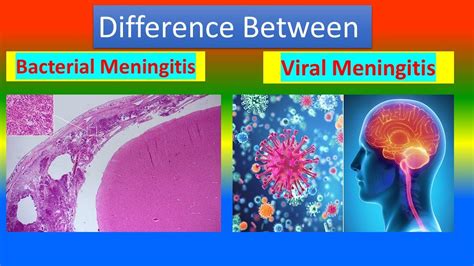 Viral Meningitis 💖viral Meningitis