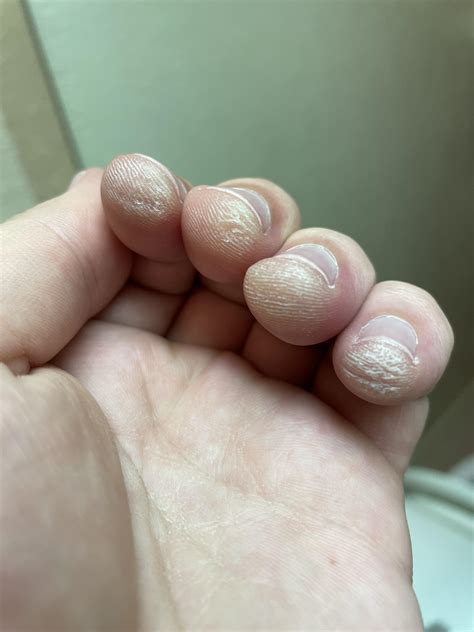 What Do Guitar Calluses Look Like With Photos Guitaresque