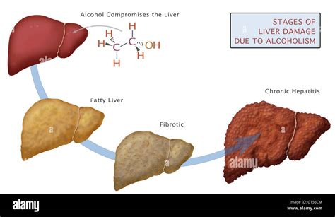 Stages Of Liver Damage Due To Alcoholism First Alcohol Compromises