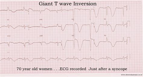 Deep T Wave Inversion Dr S Venkatesan Md Free Hot Nude Porn Pic Gallery