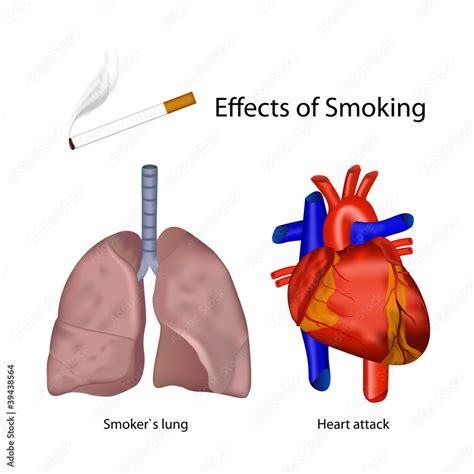 Smokers Human Heart