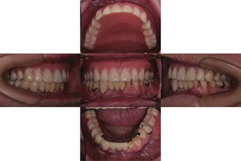 Intraoral Views With Definitive Dentures A Maxillary Occlusal View