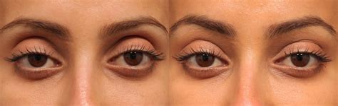 Non Surgical Upper Eyelift For Hollow Eyes Sydney Shape Clinic