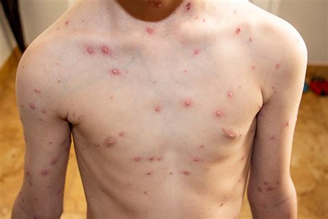 12 Common Skin Rashes In Children And Their Treatments