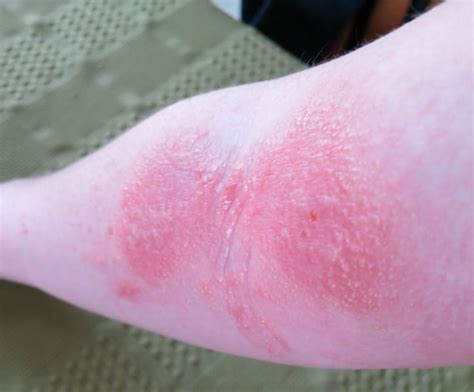 2013 Photos Of Poison Ivy Rashes Poison Ivy Cures Help And Information