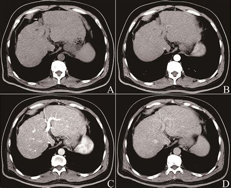 Giant Hepatic Regenerative Nodule In A Patient With Hepatitis B Virus