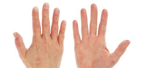 It typically appears on the legs, arms or chest. Take this Winter Hand Eczema Quiz! | DermUtopia