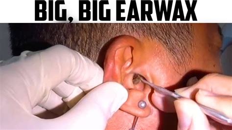 Earwax Removal And Peroxide Cleaning Earwax Specialist Youtube