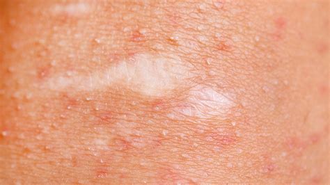 How To Prevent And Treat 8 Common Skin Conditions Everyday Health