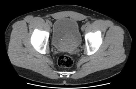 Ct Image Showing A Large Bladder Tumor On The Posterior Bladder Wall