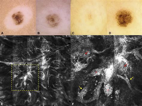Recurrent Halo Nevus Dermoscopy And Confocal Microscopy Features
