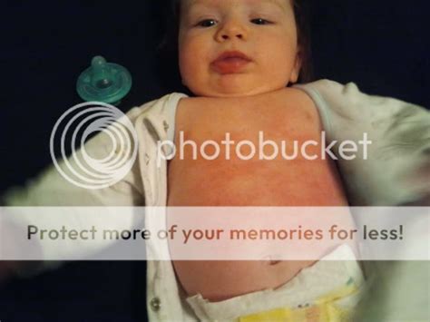 Whats This Rash On Bbs Tummy Pic Added Babycenter