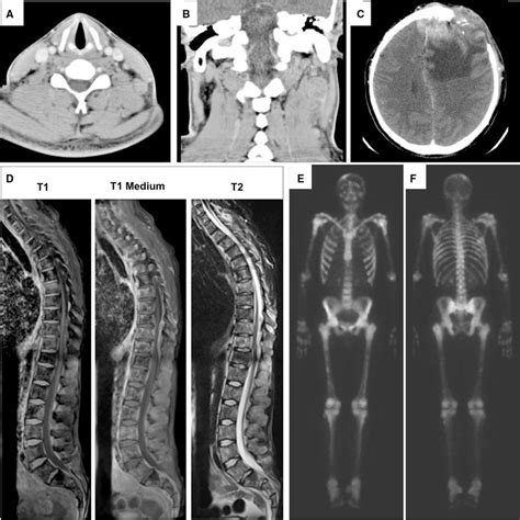 Ct Scans Showed Multiple Heterogeneous Cervical Lymph Nodes With Uptake