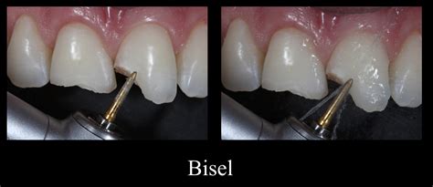 Caso Clínico Reconstrução Estética Em Resina Composta Surya Dental