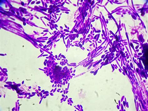 Fungal Infections Worldwide Are Becoming Resistant To Drugs And More Deadly