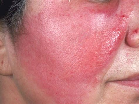 Cellulitis Rash Stages