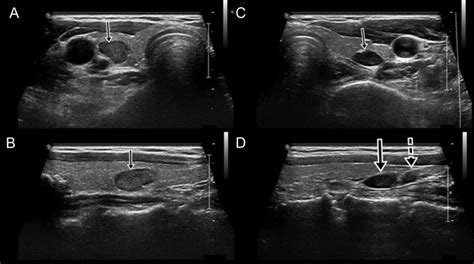 Parathyroid Ultrasound Anatomy