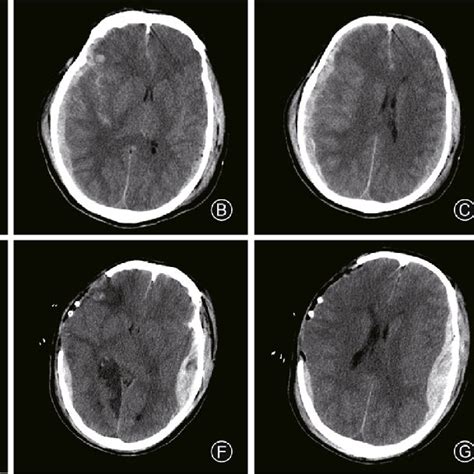 A 56 Year Old Man With Progressive Epidural Hematoma After Fall Case