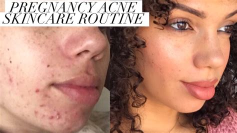Pregnancy Acne How To Control Bad Breakouts Youtube
