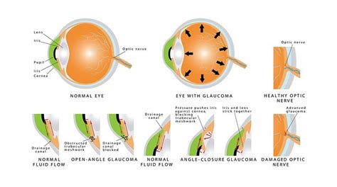 Diagnosing And Treating Glaucoma Ophthalmic Associates Southern Tier