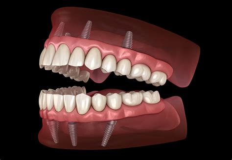 implant supported dentures voss dental oral surgery implant