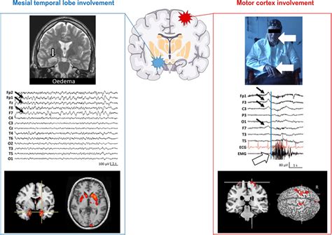 Two Main Targets Of Anti Lgi1 Encephalitis Mesial Temporal Lobe And