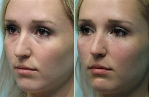 Injections Tear Trough Under Eye Injections Photos Chevy Chase Md Patient 15127
