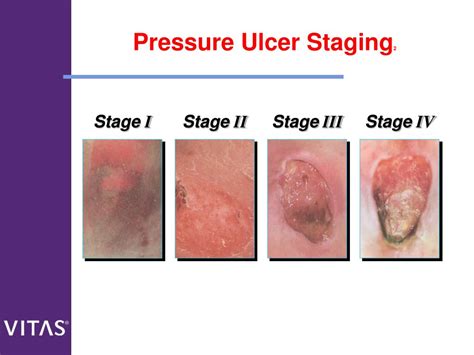 Stage Pressure Ulcer Treatment