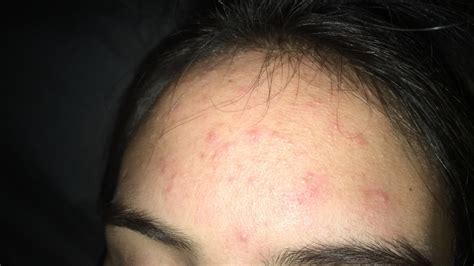 Skin Concerns Any Help Guys Ive Had This For 2 Years And Tried