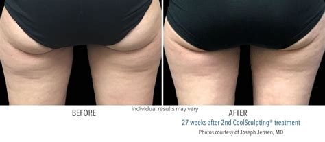 Coolsculpting Before And After Fat Freezing Body Transformations