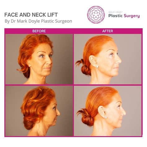 Neck Lift Gold Coast And Brisbane Neck Renewal Dr Mark Doyle